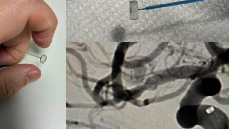 Intervención endovascular en el Hospital San Martín de La Plata